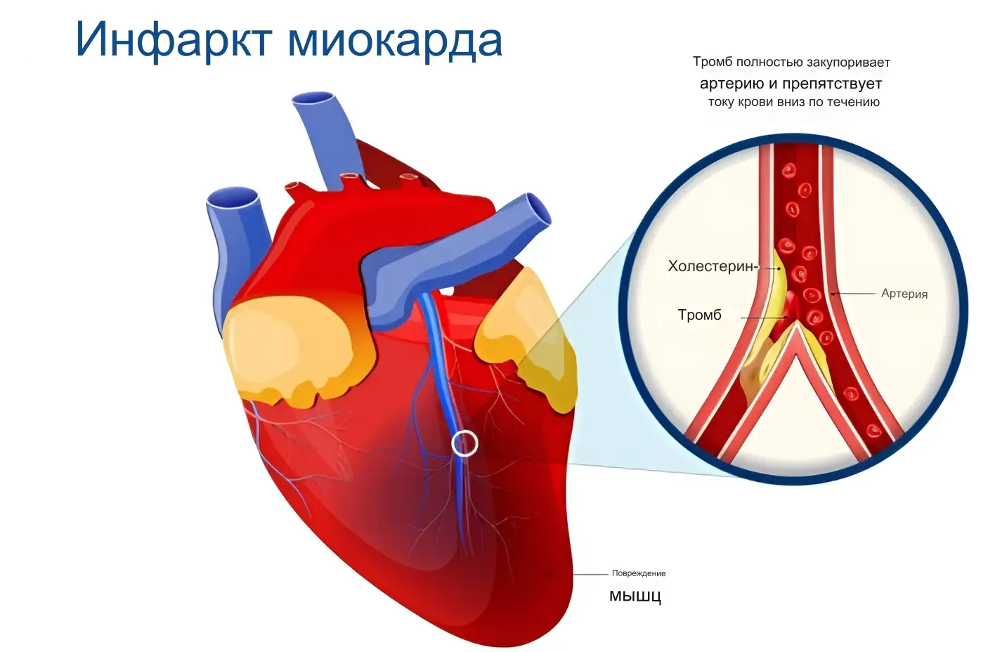 Инфаркт миокарда Инфаркт миокарда