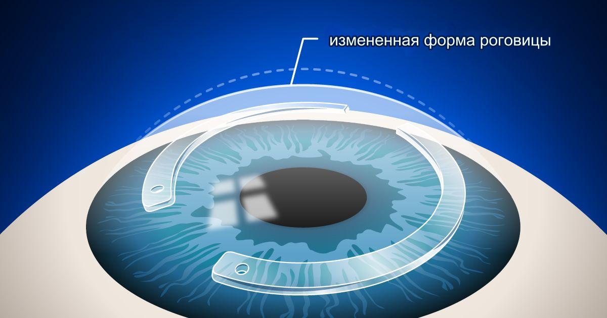 Интракорнеального кольца при дистрофии роговицы Интракорнеального кольца при дистрофии роговицы