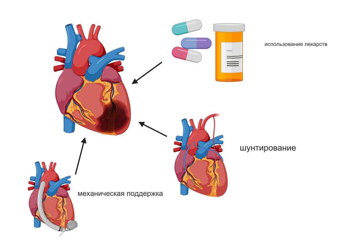 Лечение инфаркта миокарда Лечение инфаркта миокарда