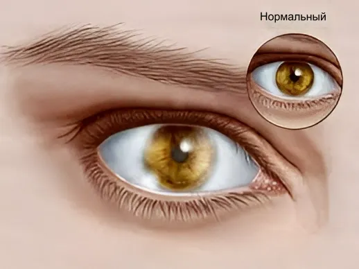Дистрофия роговицы Дистрофия роговицы