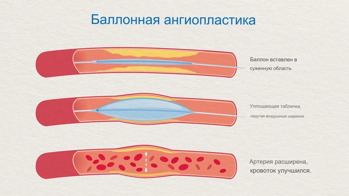 Ангиопластика Ангиопластика