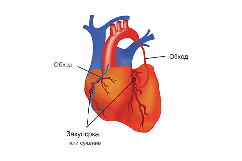 Шунтирование Шунтирование