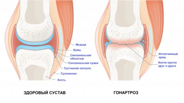 Как выглядит гонартроз Как выглядит гонартроз