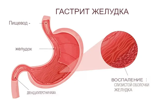 Гастрит Гастрит