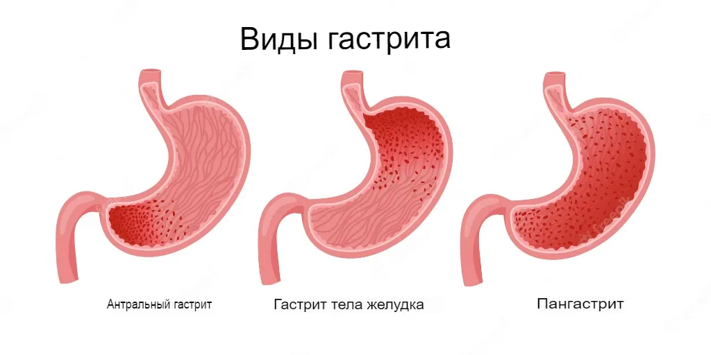 Виды гастрита Виды гастрита