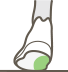 пронация_гиперпронация.png