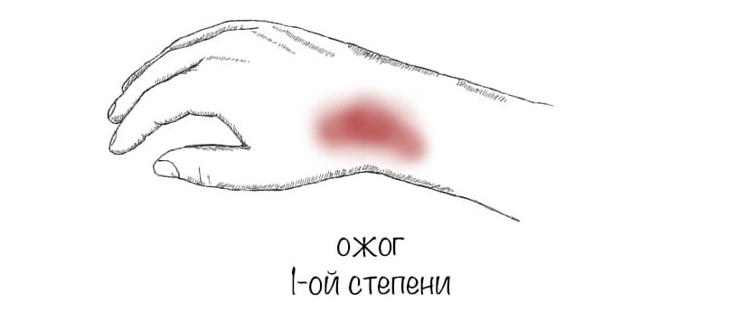 Ожог 1 степени
