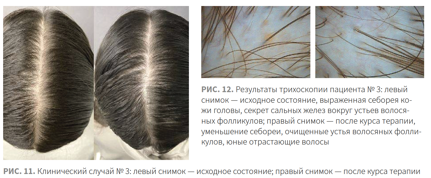 Ибатуллина (КМ 2-2023 (Ипсен) Рис 11-12 Ибатуллина (КМ 2-2023 (Ипсен) Рис 11-12.png
