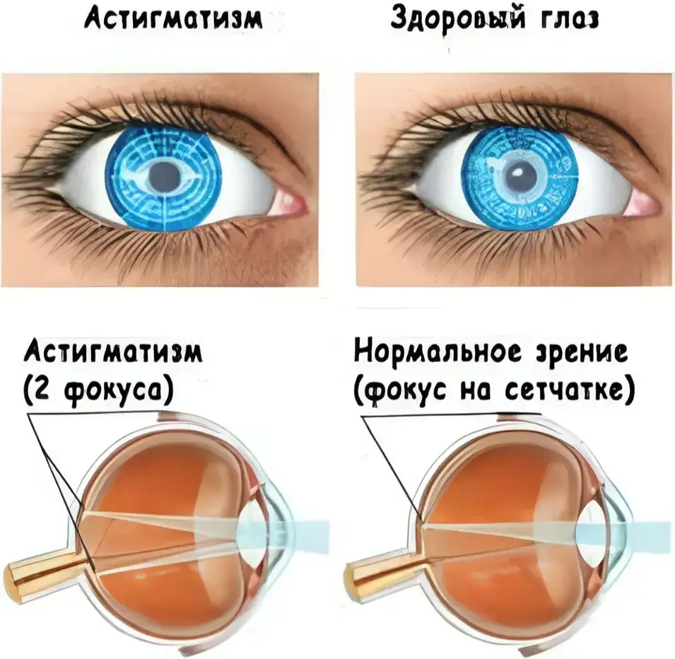 Астигматизм Астигматизм