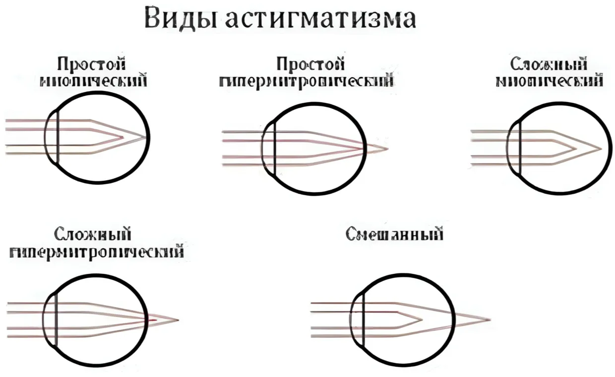 Виды астигматизма Виды астигматизма