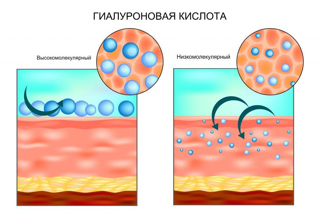 Какие бывают виды гиалуроновой кислоты Какие бывают виды гиалуроновой кислоты