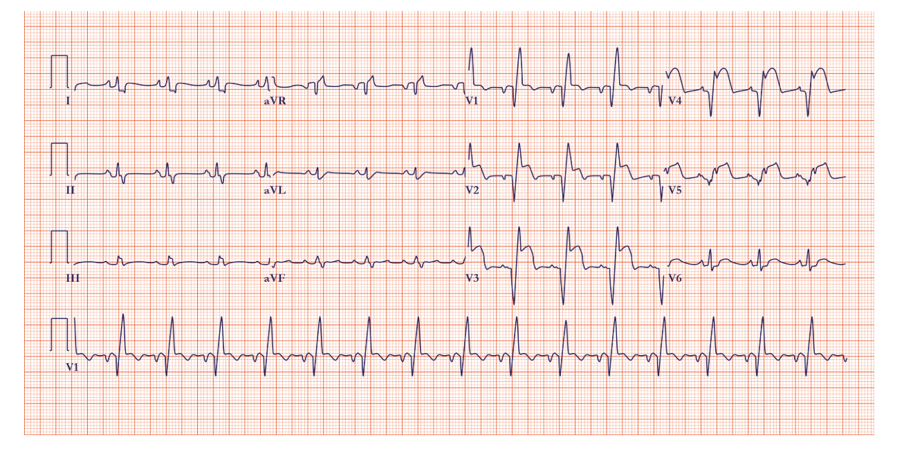 EKG-pri-infarkte EKG-pri-infarkte