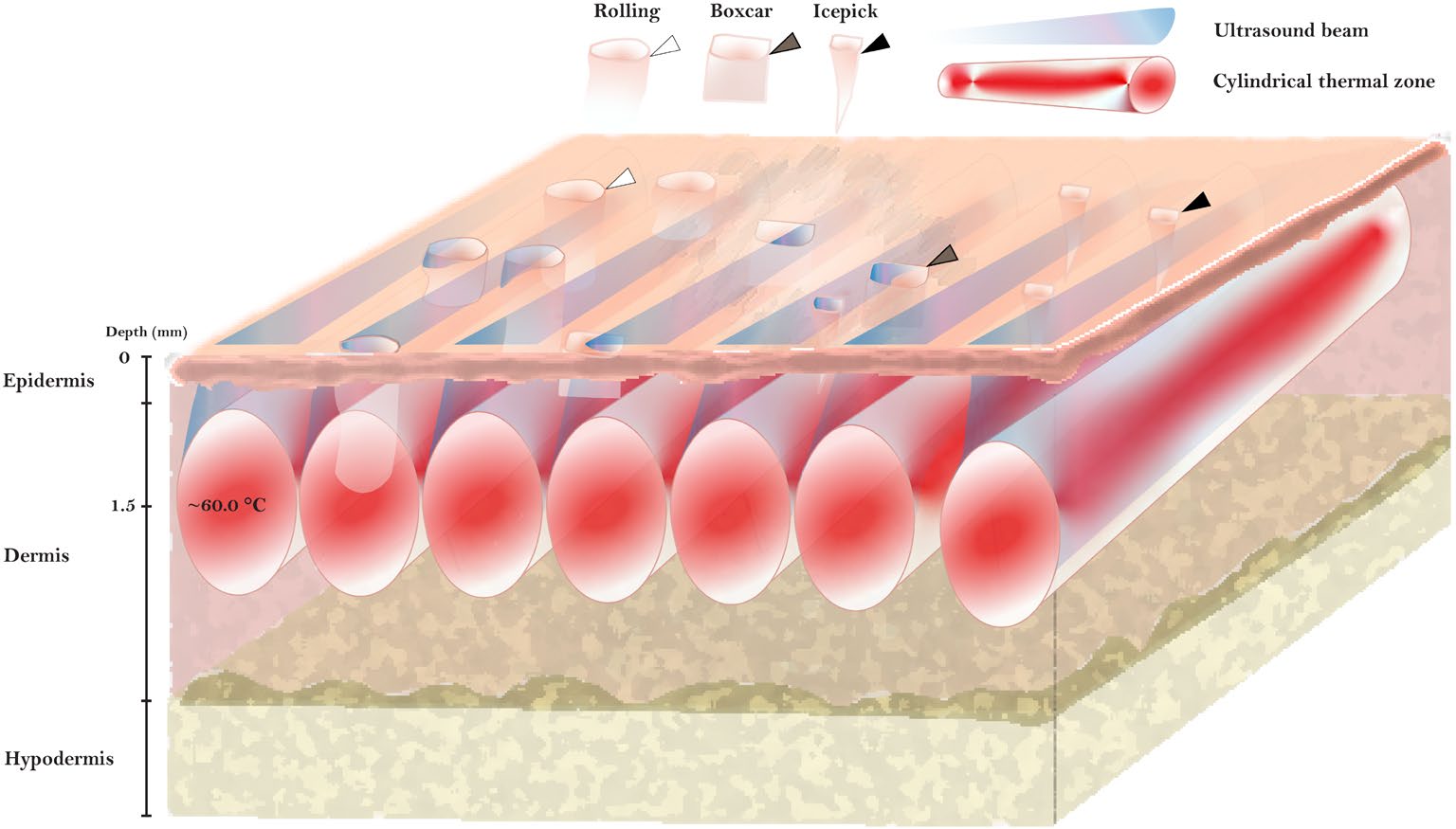 US Parallel for Acne scars_FIG US Parallel for Acne scars_FIG.jpeg