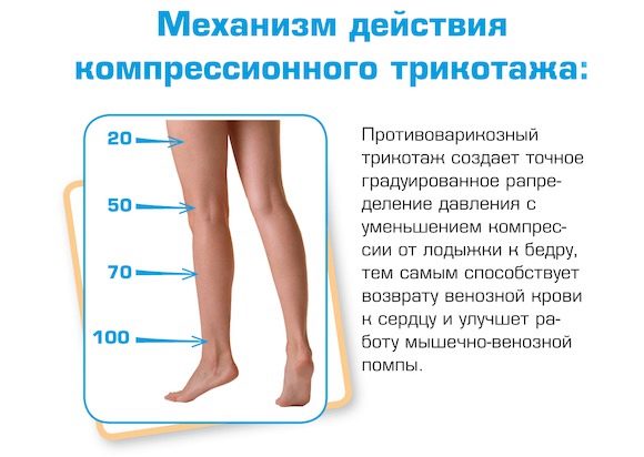 Профилактика и лечение варикоза вен ног
