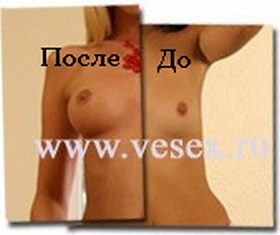 Увеличение груди без операции