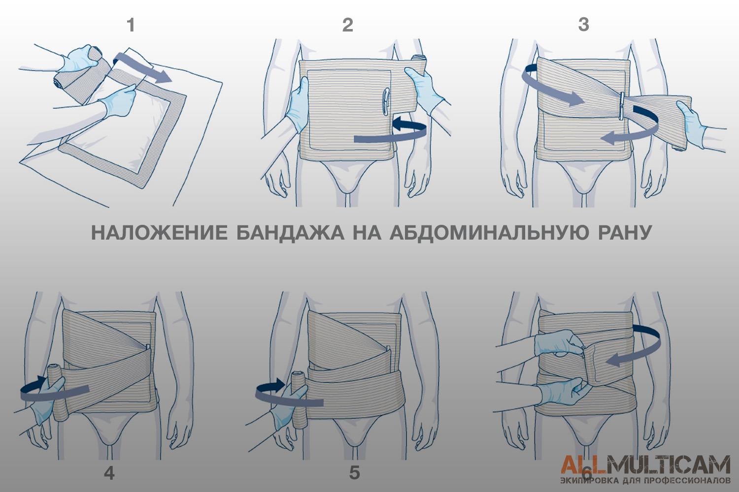 наложение бандажа First Care на абдоминальную рану
