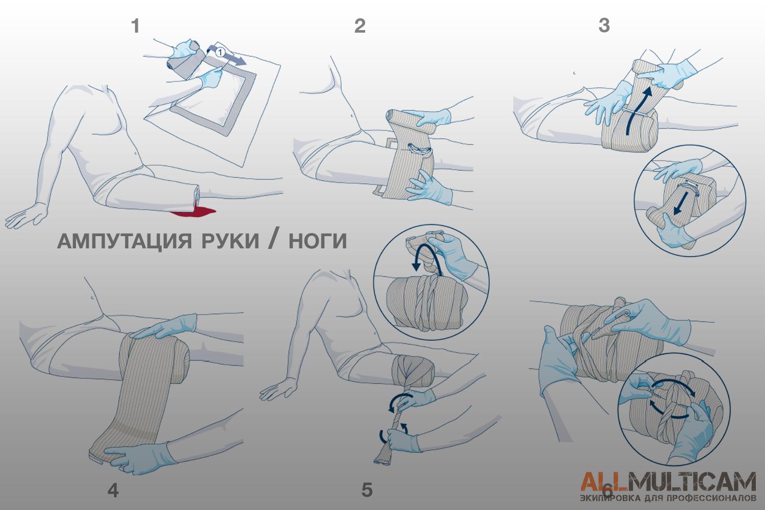 использование повязки First Care при ампутации конечности