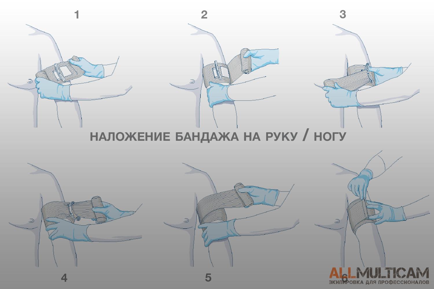 наложение бандажа на руку / ногу