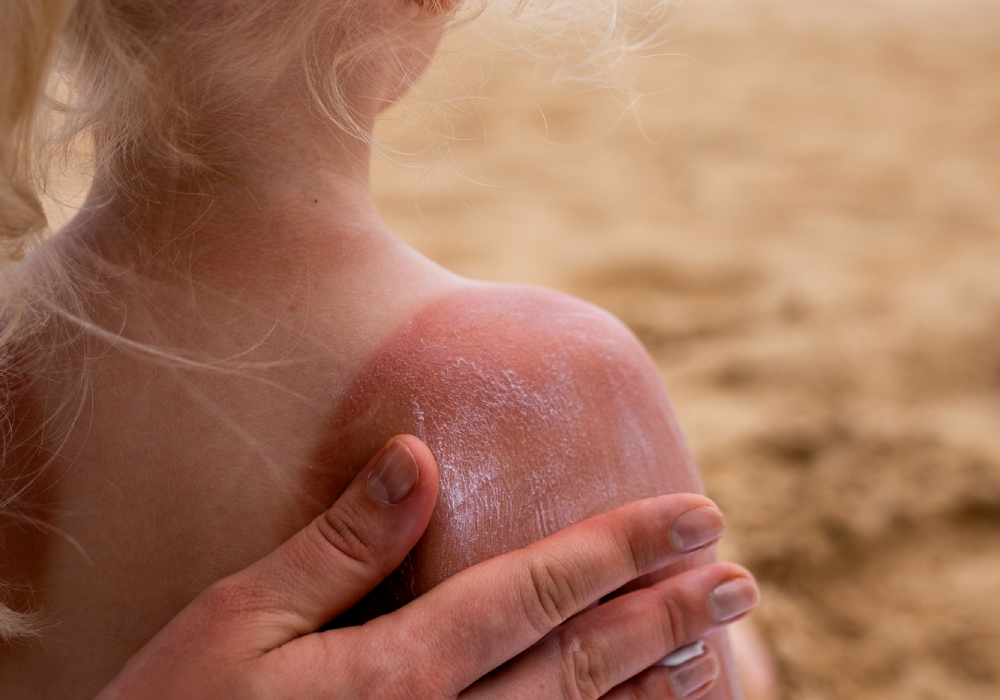 Польза SPF-средств для защиты кожи от солнца SPF-средства помогают защищать кожу от ожогов, фотостарения, пигментации и неровного тона