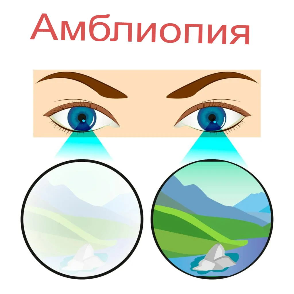 Симптомы амблиопии Симптомы амблиопии