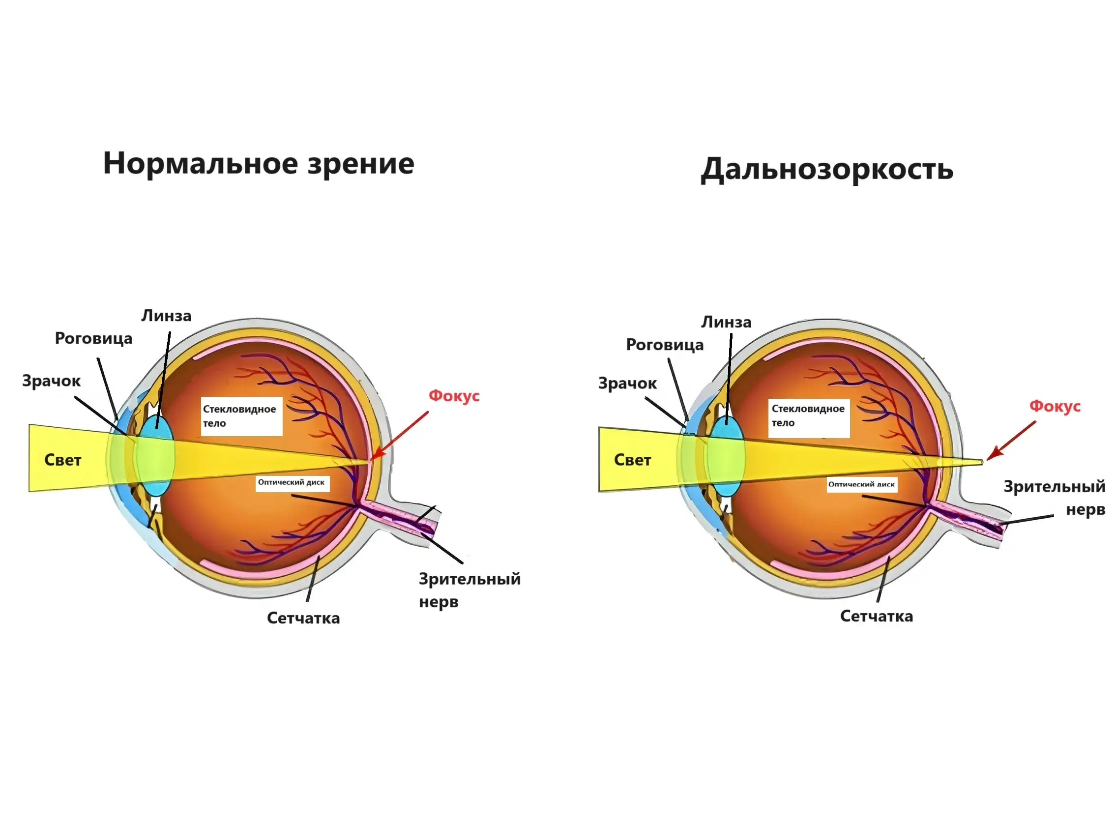 Дальнозоркусть_2