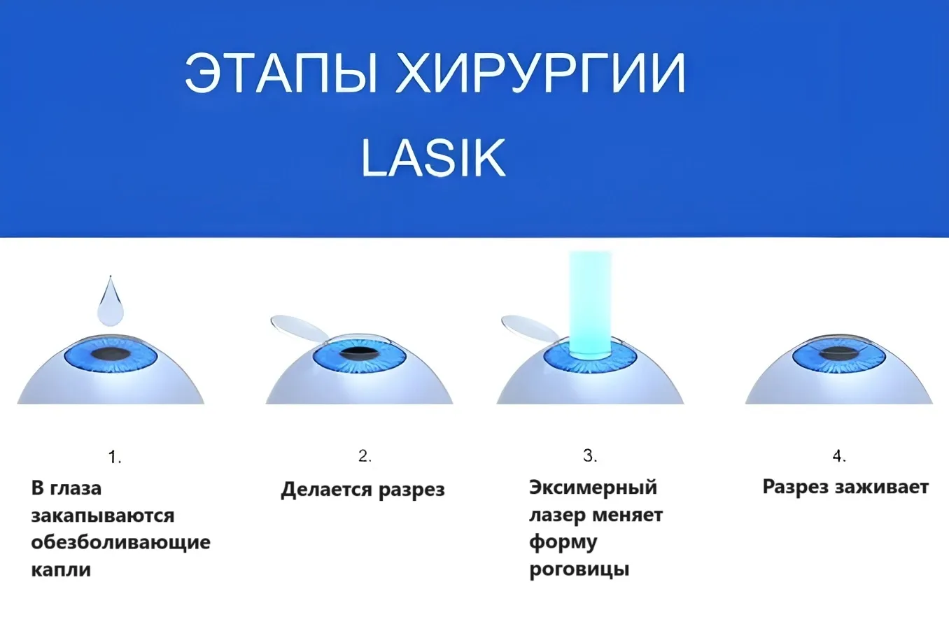 LASIK