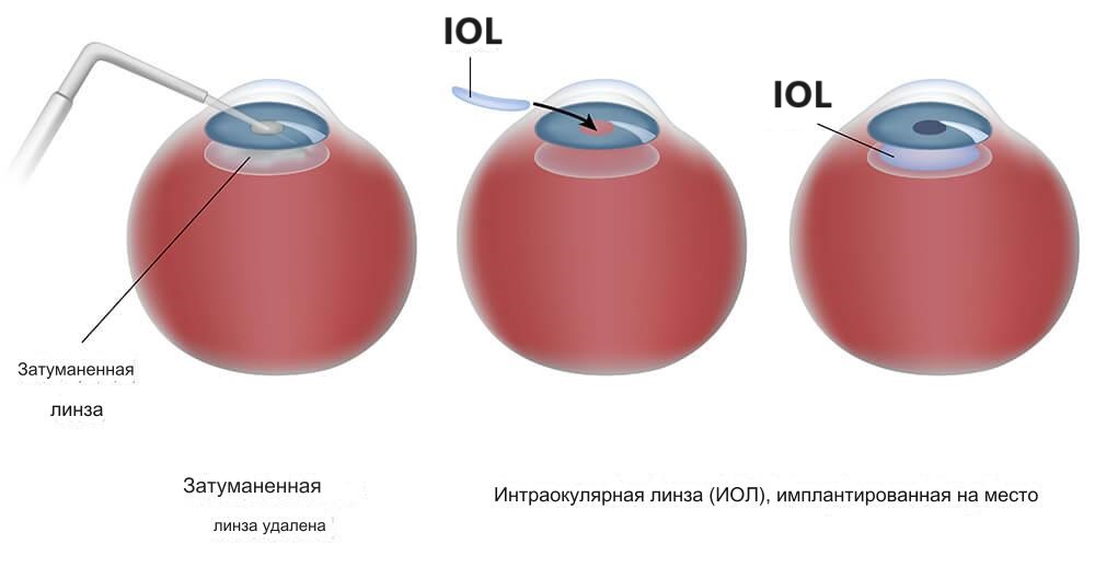 IOL