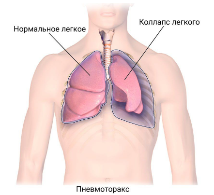 Что такое пневмоторакс