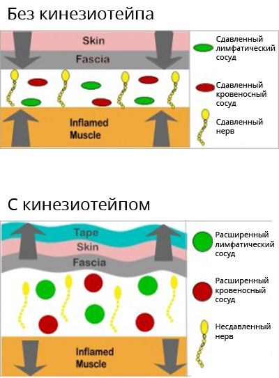 Как кинезиотейп борется с отеками и синяками Как кинезиотейп борется с отеками и синяками