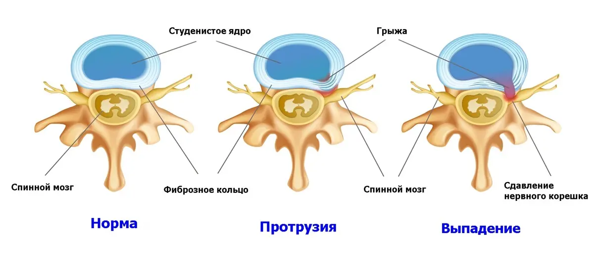 грыжа межпозвонкового диска
