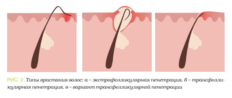 Типы врастания волос.png