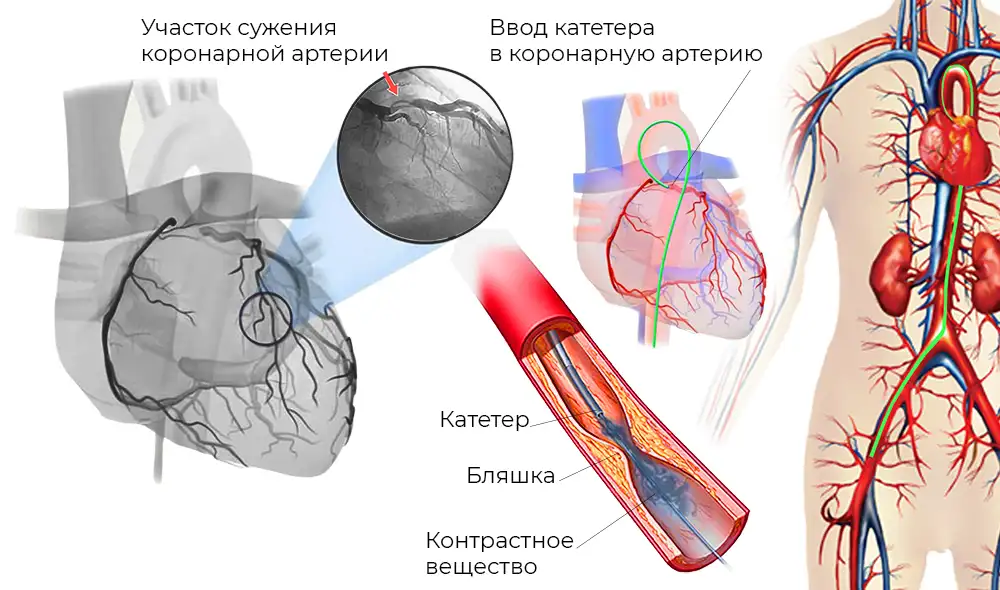 Инвазивная коронарография