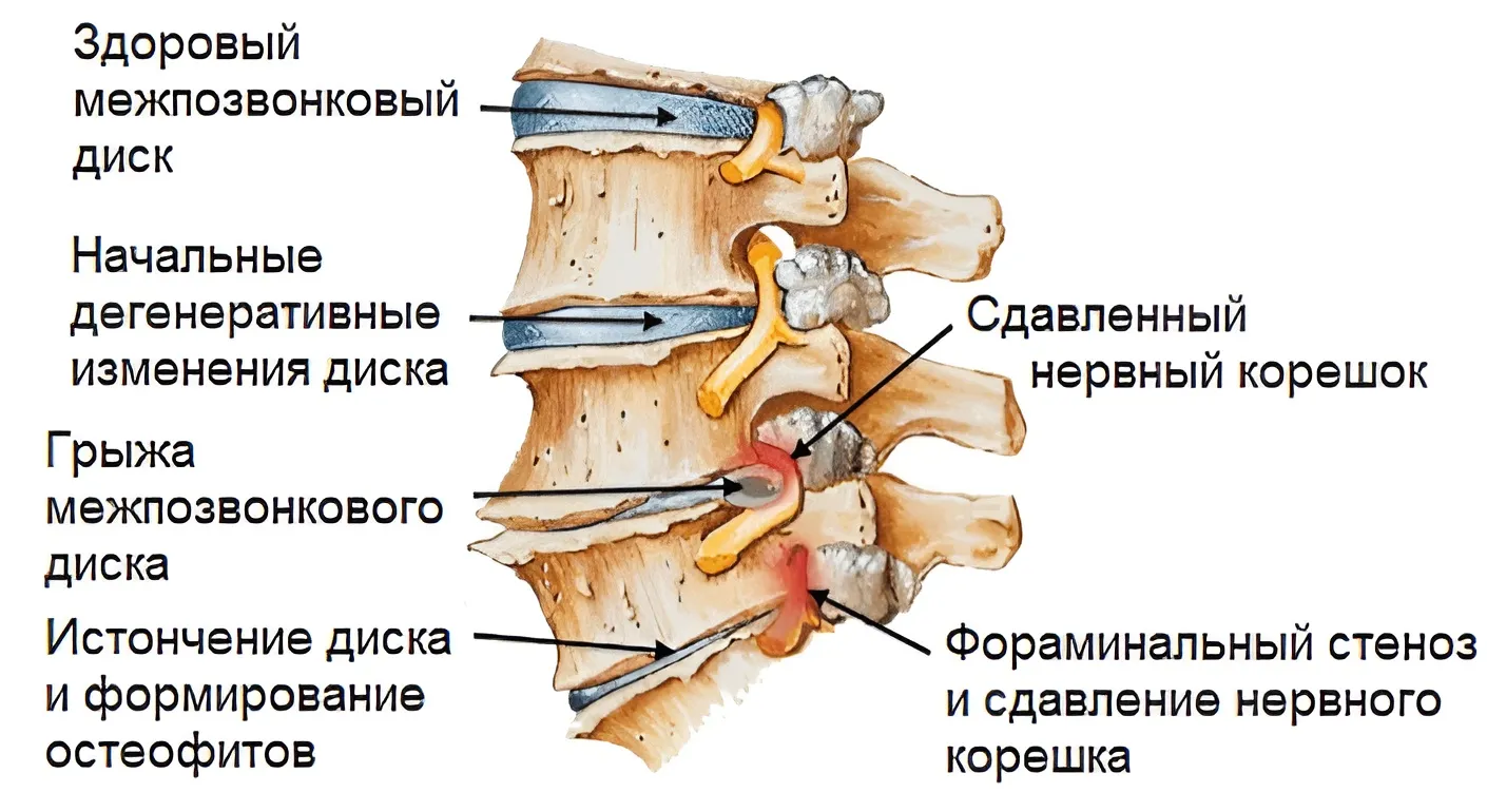корешковый синдром 2 корешковый синдром 2
