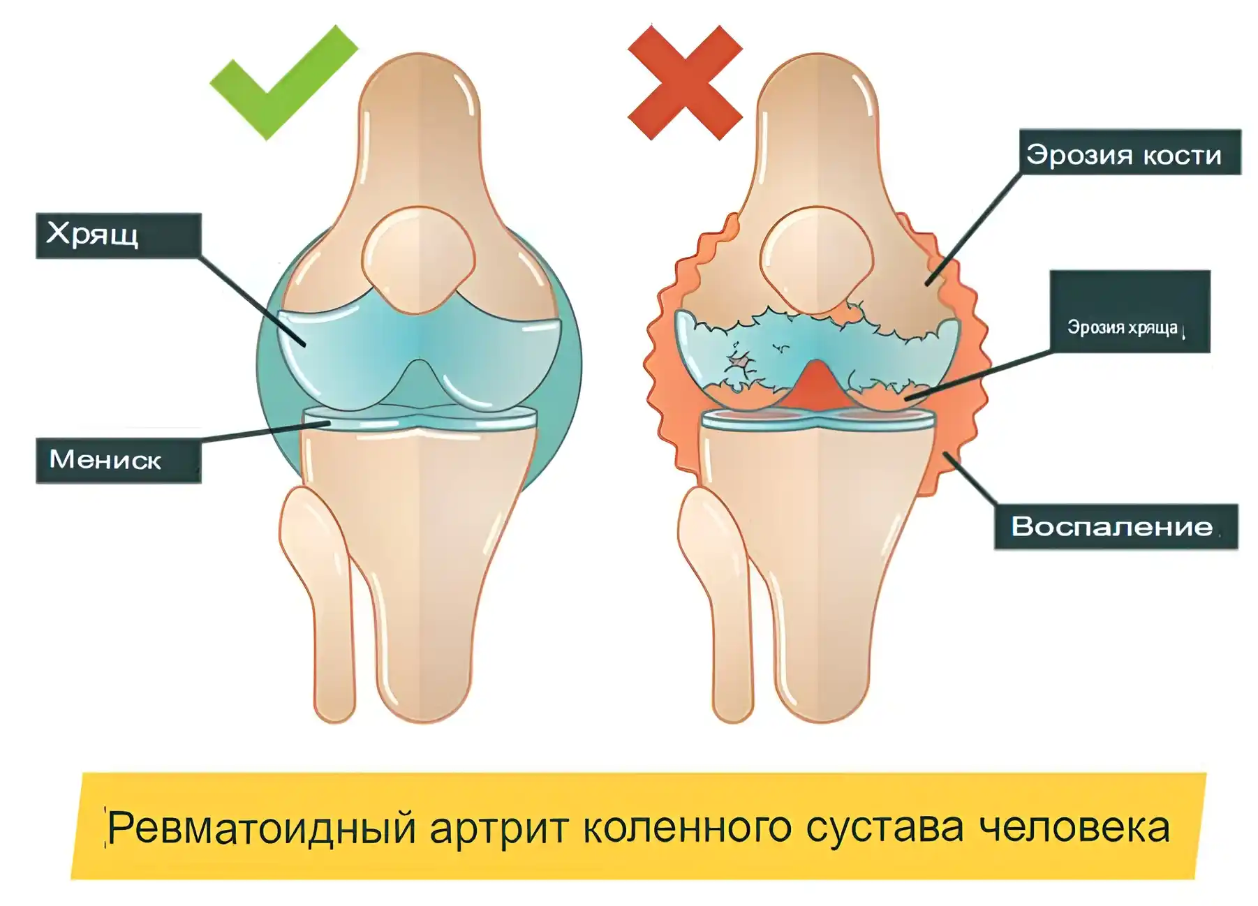 Ревматоидный артрит Ревматоидный артрит