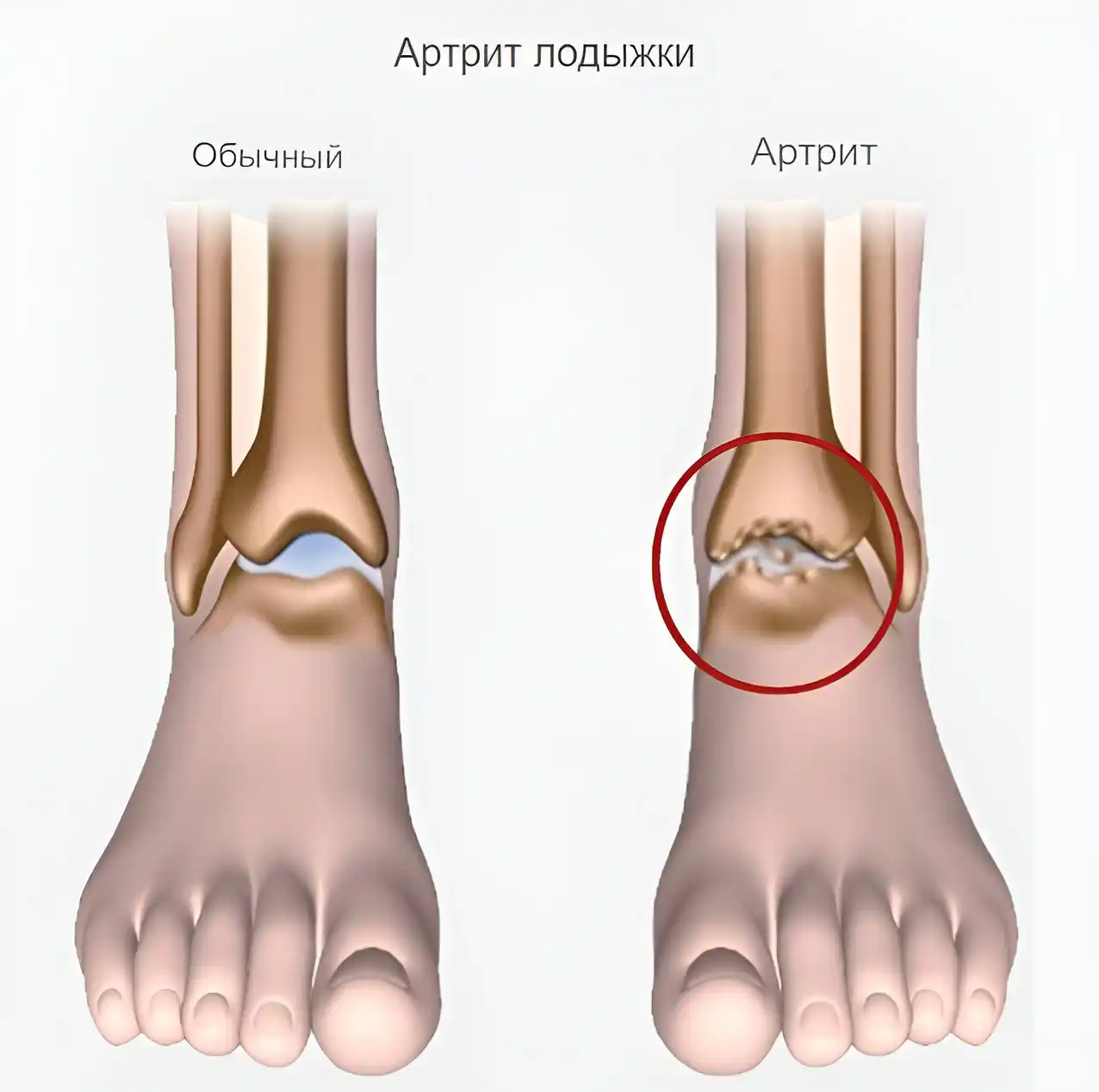 Артрит лодыжки Артрит лодыжки