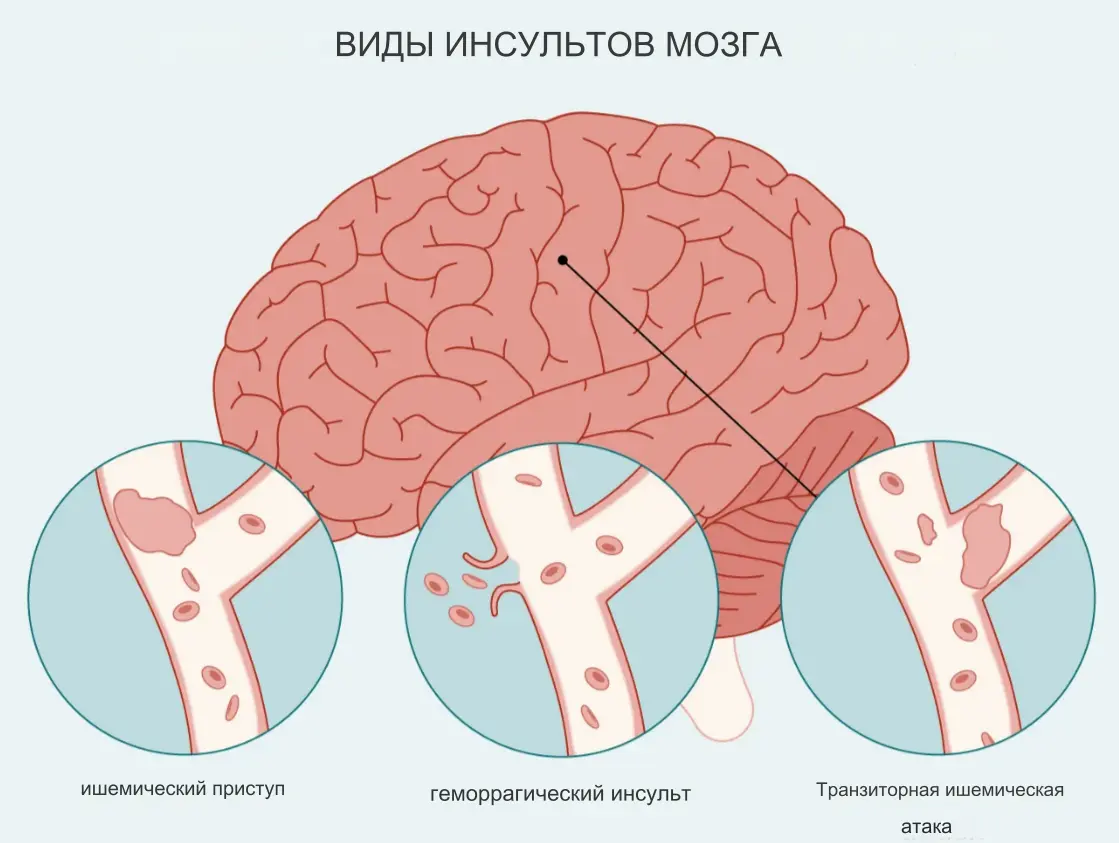 Виды инсультов Виды инсультов