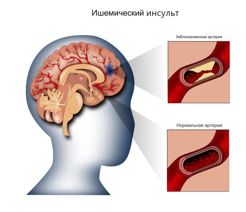Ишемический_инсульт Ишемический_инсульт