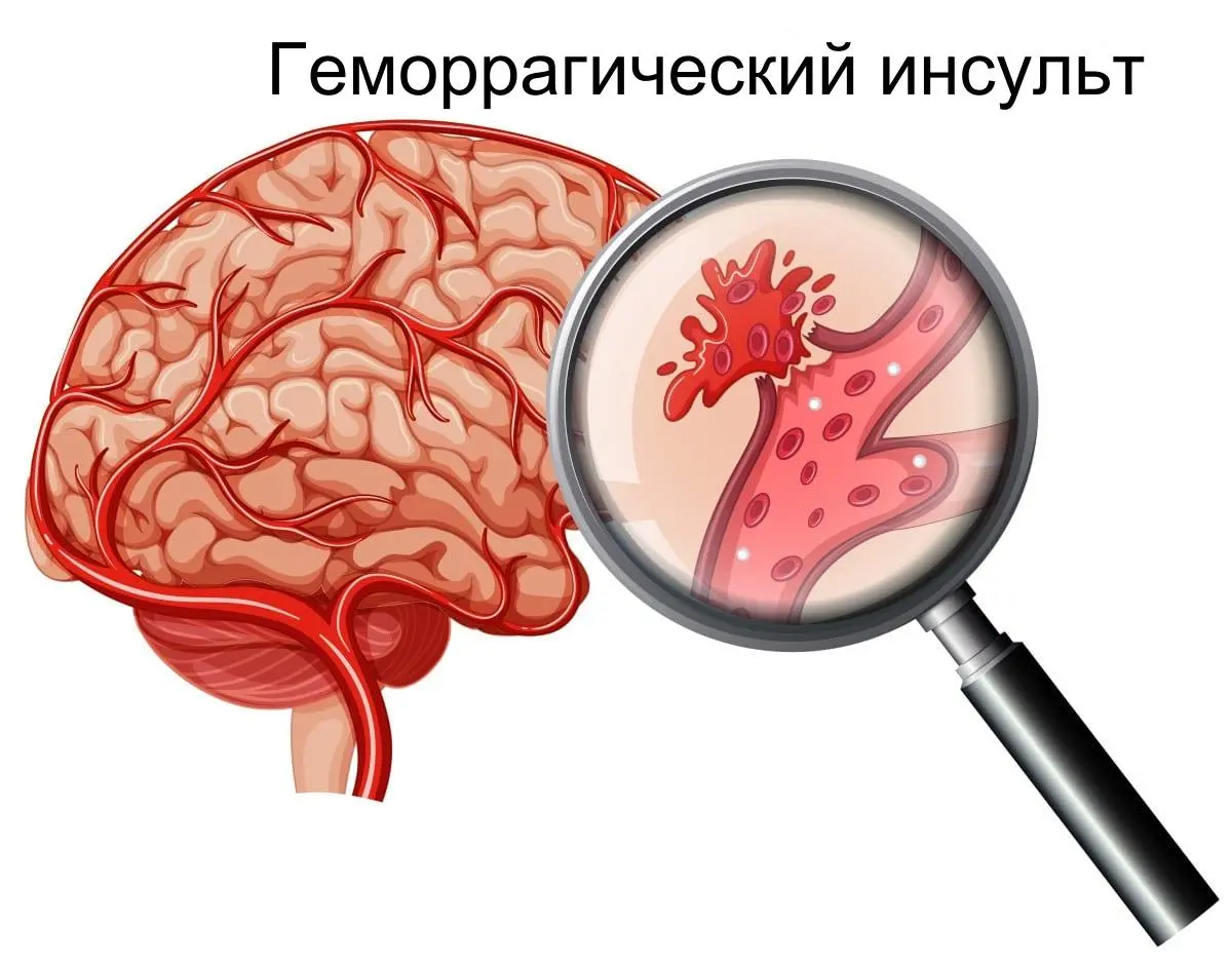 Геморрагический-инсульт Геморрагический-инсульт