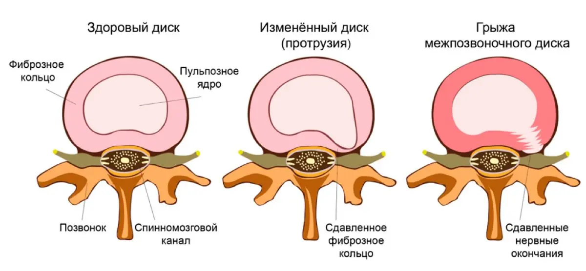 Cтадии развития межпозвоночной грыжи межпозвоночная грыжа