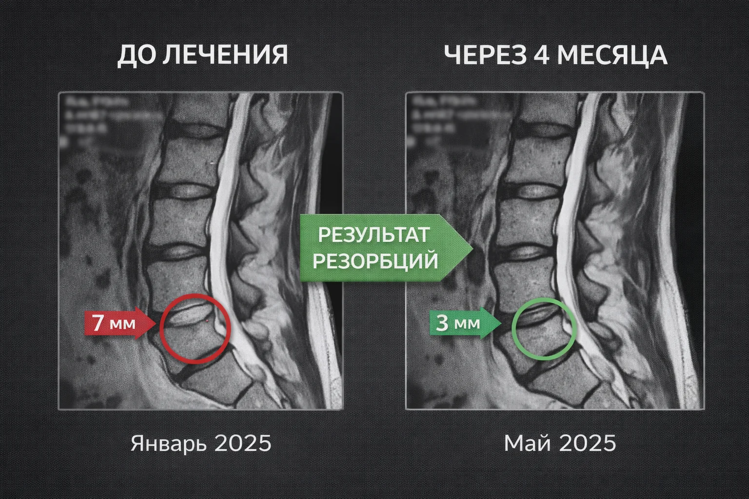 mri_rezorbciya_do_posle_web.webp