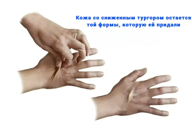 Тургор кожи Тургор кожи