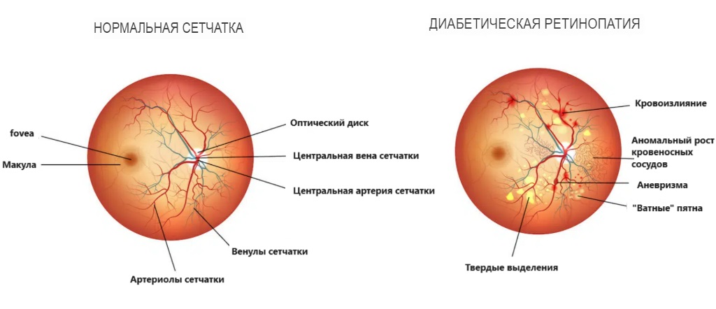 Диабетическая ретинопатия Диабетическая ретинопатия