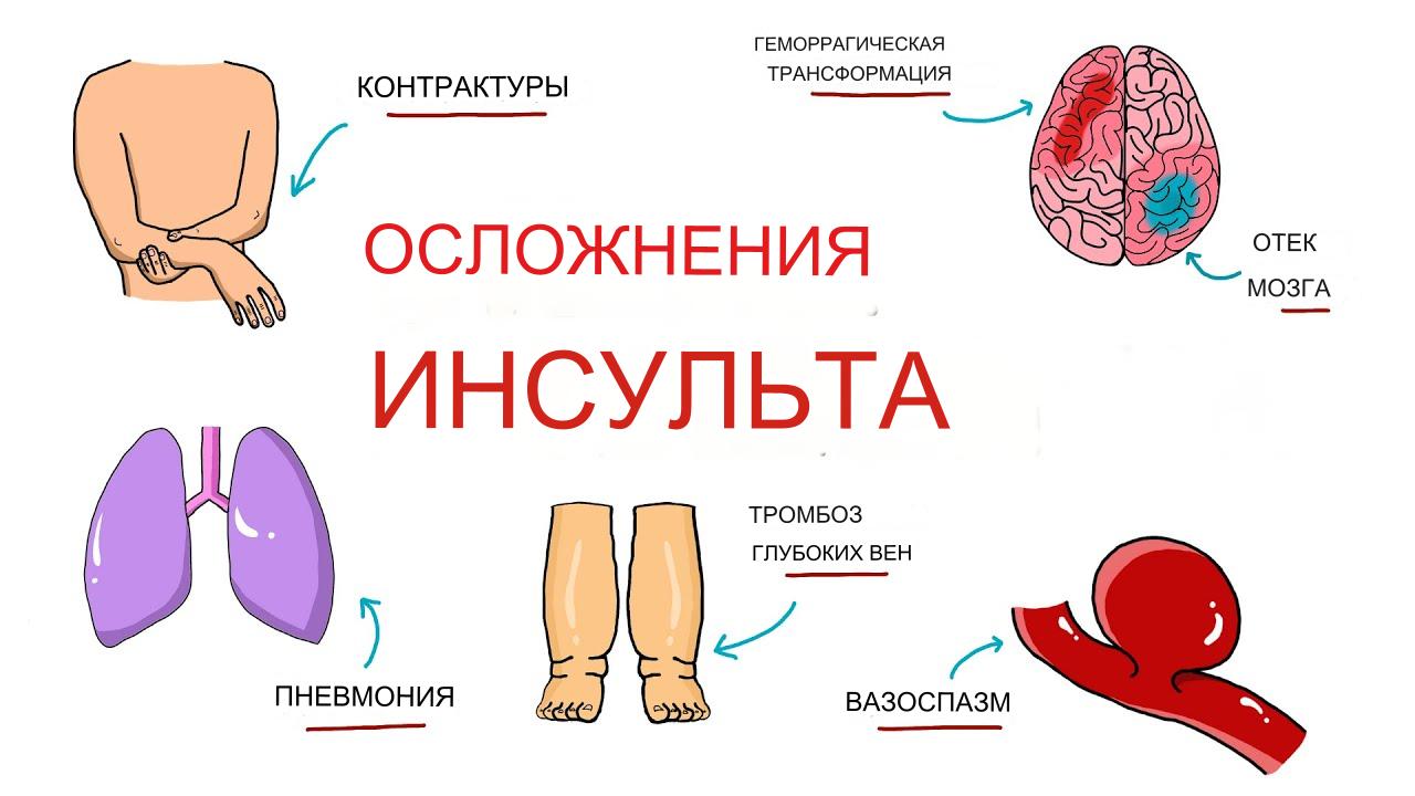 Осложнения инсульта Осложнения инсульта