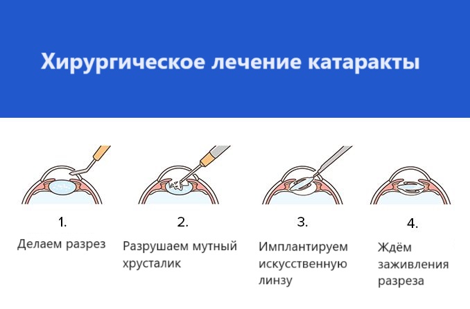 Хирургическое лечение катаракты