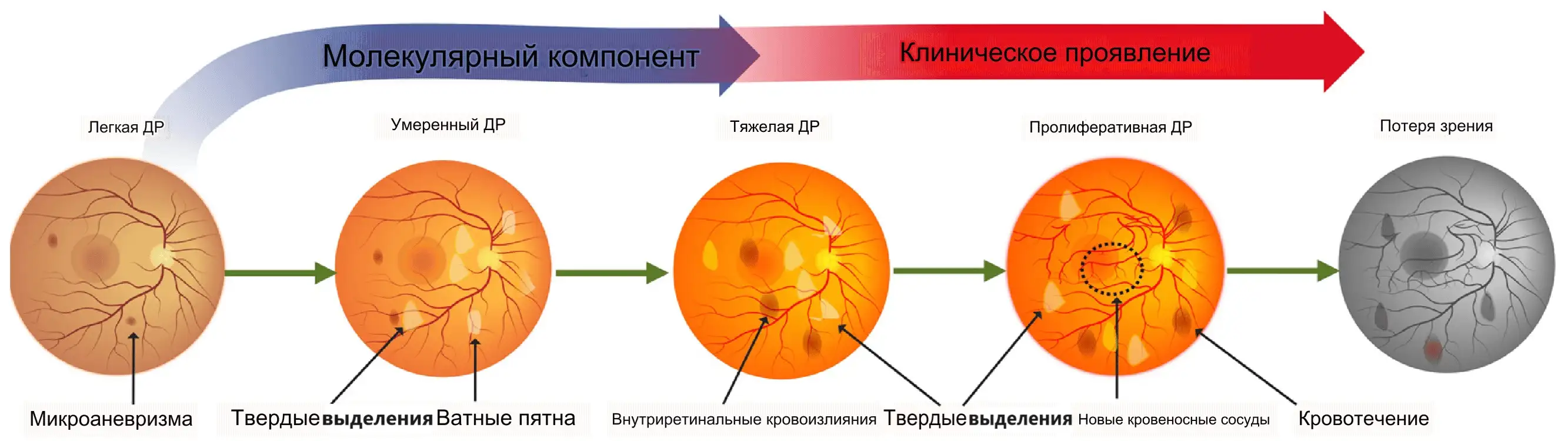 Стадии диабетической ретинопатии Стадии диабетической ретинопатии