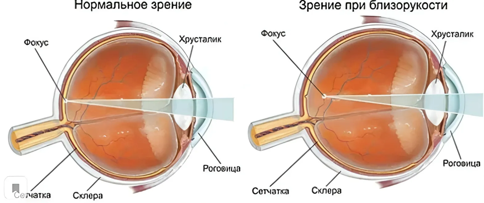 Миопия (Близорукость) Миопия (Близорукость)