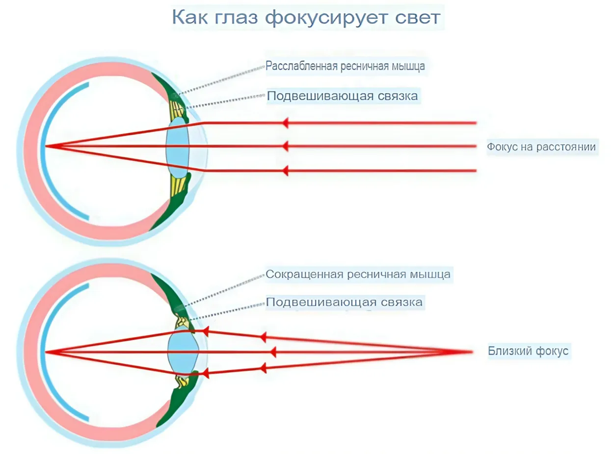 Миопия (Близорукость) 2 Миопия (Близорукость) 2