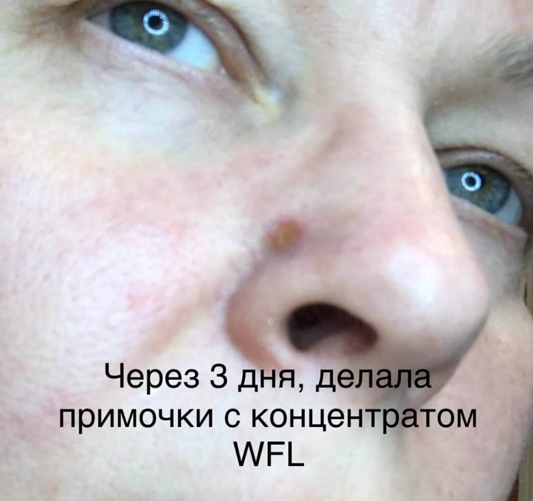 родинка гидроплазма