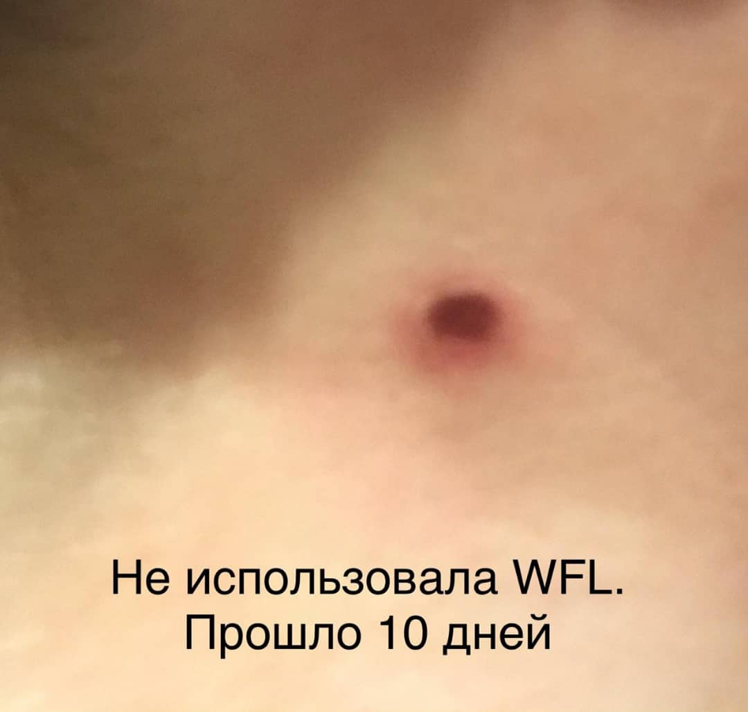 родинка 3