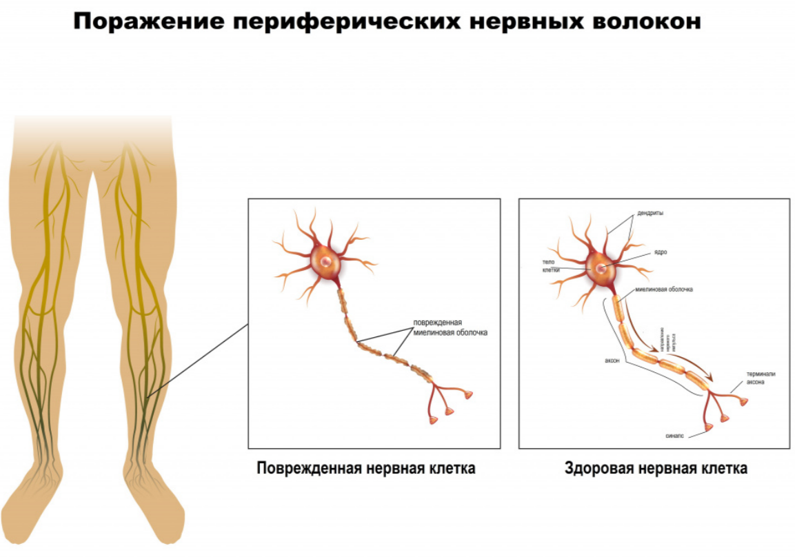 Поражение нервных волокон